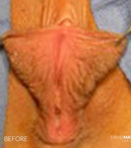Labia Minora Before & After Patient #2782