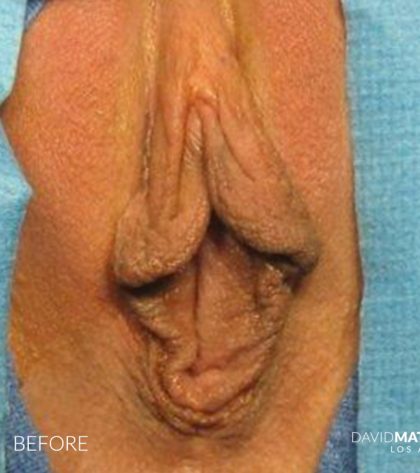 Labia Minora Before & After Patient #2784