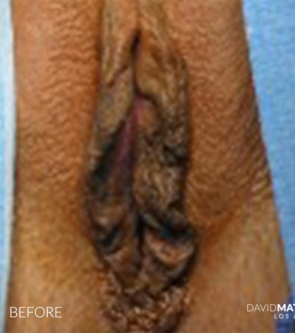 Labia Minora Before & After Patient #2785