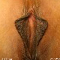 Labia Minora Before & After Patient #2786