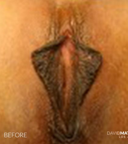Labia Minora Before & After Patient #2786