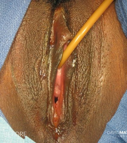 Laser Vaginal Rejuvenation Before & After Patient #2814