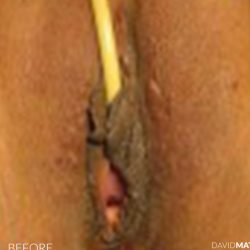 Laser Vaginal Rejuvenation Before & After Patient #2815