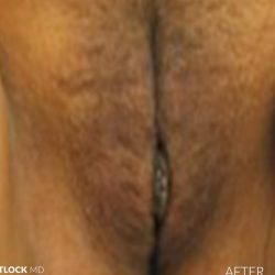 Laser Vaginal Rejuvenation Before & After Patient #2815