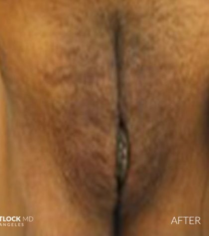 Laser Vaginal Rejuvenation Before & After Patient #2815