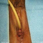Laser Vaginal Rejuvenation Before & After Patient #2816