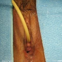 Laser Vaginal Rejuvenation Before & After Patient #2816