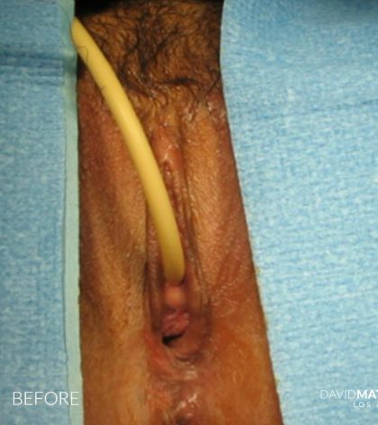 Laser Vaginal Rejuvenation Before & After Patient #2816
