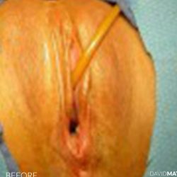 Laser Vaginal Rejuvenation Before & After Patient #2817