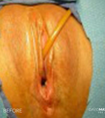 Laser Vaginal Rejuvenation Before & After Patient #2817