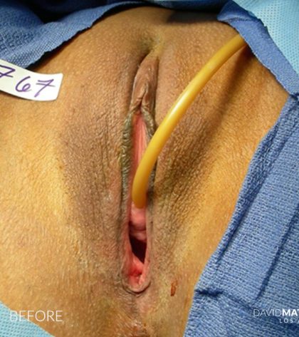 Laser Vaginal Rejuvenation Before & After Patient #2819