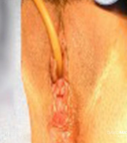 Laser Vaginal Rejuvenation Before & After Patient #2803