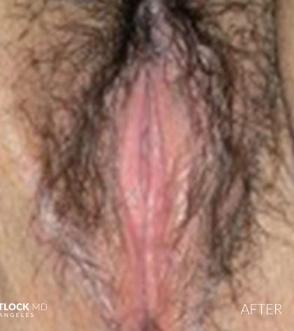 Laser Vaginal Rejuvenation Before & After Patient #2803