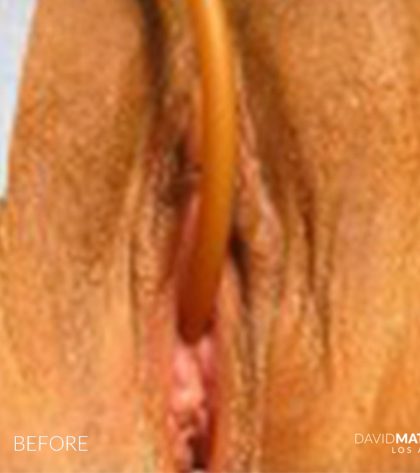 Laser Vaginal Rejuvenation Before & After Patient #2806