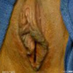 Laser Vaginal Rejuvenation Before & After Patient #2807