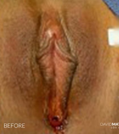 Laser Vaginal Rejuvenation Before & After Patient #2808