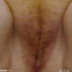Laser Vaginal Rejuvenation Before & After Patient #2809
