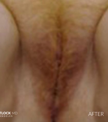 Laser Vaginal Rejuvenation Before & After Patient #2809