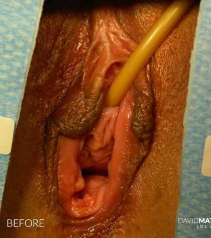 Laser Vaginal Rejuvenation Before & After Patient #2810