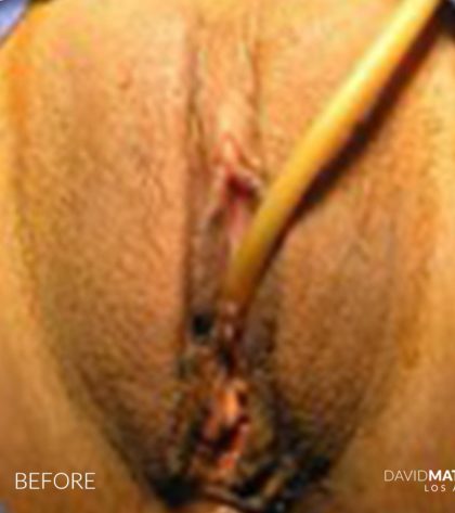 Laser Vaginal Rejuvenation Before & After Patient #2811