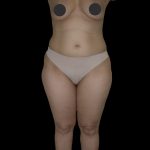 Liposuction Female Before & After Patient #2747