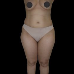 Liposuction Female Before & After Patient #2747