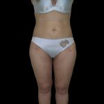 Liposuction Female Before & After Patient #2747