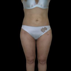 Liposuction Female Before & After Patient #2747
