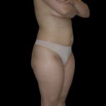 Liposuction Female Before & After Patient #2747