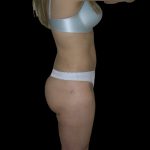 Liposuction Female Before & After Patient #2747