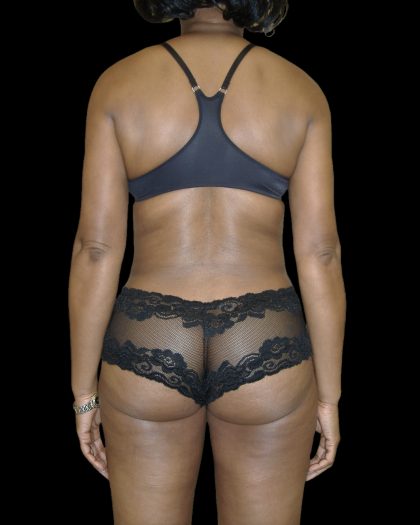Liposuction Female Before & After Patient #2748
