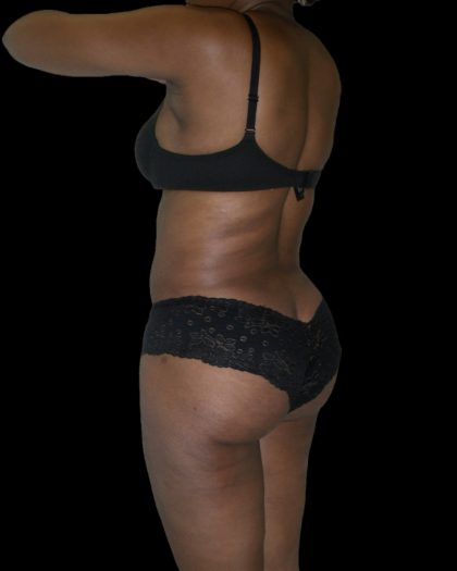 Liposuction Female Before & After Patient #2748