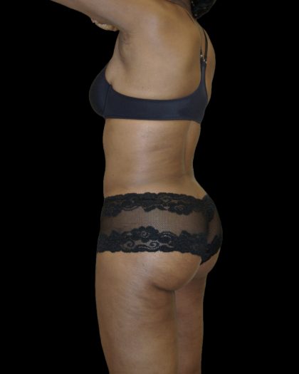 Liposuction Female Before & After Patient #2748