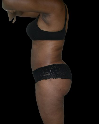 Liposuction Female Before & After Patient #2748