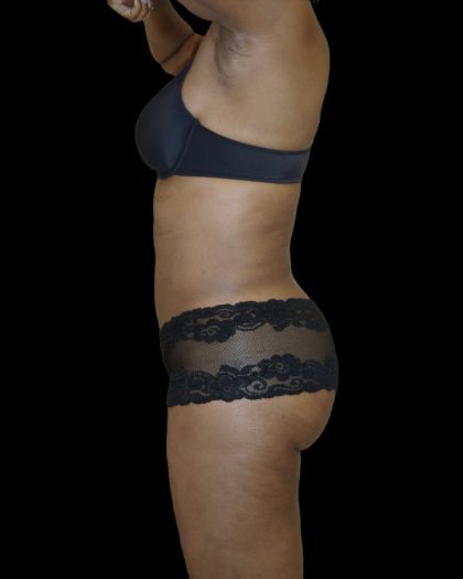 Liposuction Female Before & After Patient #2748