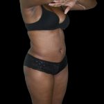 Liposuction Female Before & After Patient #2748