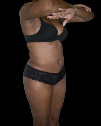 Liposuction Female Before & After Patient #2748