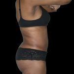 Liposuction Female Before & After Patient #2748