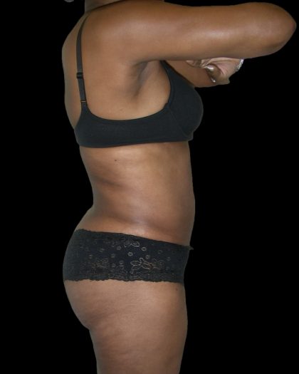 Liposuction Female Before & After Patient #2748