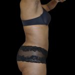 Liposuction Female Before & After Patient #2748