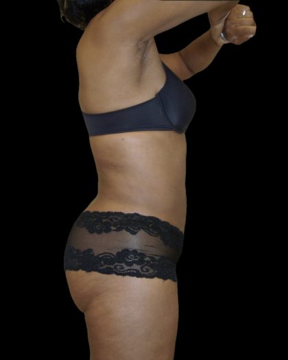 Liposuction Female Before & After Patient #2748