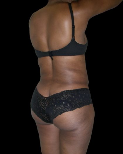 Liposuction Female Before & After Patient #2748