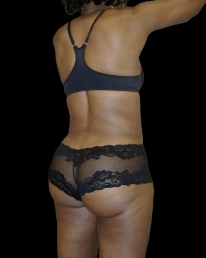 Liposuction Female Before & After Patient #2748