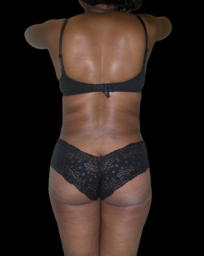 Liposuction Female Before & After Patient #2748
