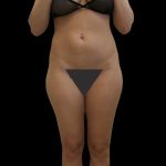 Liposuction Female Before & After Patient #2749