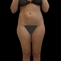 Liposuction Female Before & After Patient #2749