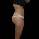 Liposuction Female Before & After Patient #2750