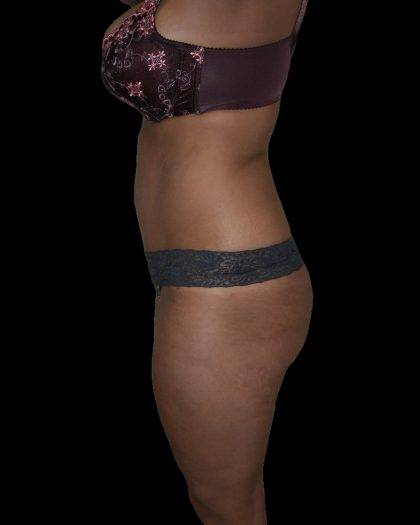Liposuction Female Before & After Patient #2751