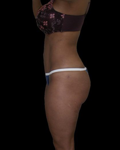 Liposuction Female Before & After Patient #2751