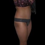 Liposuction Female Before & After Patient #2751